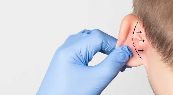 Korekcja uszu to zabieg chirurgiczny, który pozwala poprawić kształt, proporcje i symetrię małżowin usznych. Fachowo określany jako otoplastyka, jest bezpiecznym i skutecznym rozwiązaniem zarówno dla dzieci (od 7. roku życia), jak i dorosłych....